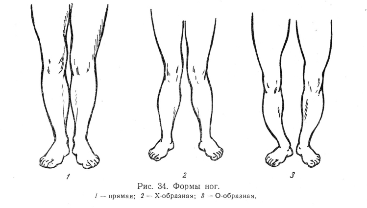 Виды формы ног ребенка